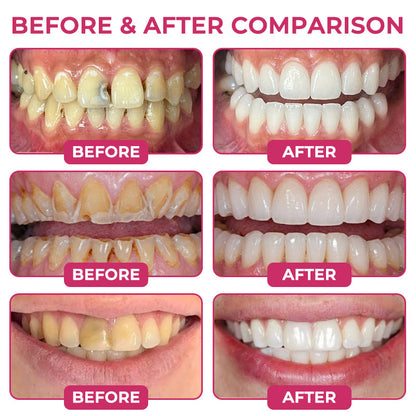 Juxek® DenPerm Cavity-Repair Natural Enamel Filling Gel