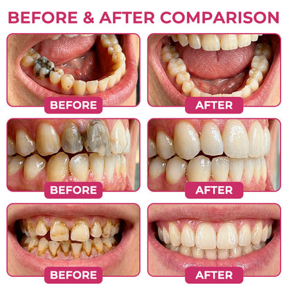 Juxek® DenPerm Cavity-Repair Natural Enamel Filling Gel